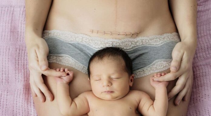 Caesarean Delivery in Noida by Dr Bhumika Caesarean Delivery in Noida