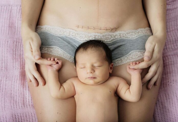 Caesarean Delivery in Noida