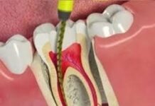 Root Canal Treatment in Noida by Floss Dental Root Canal Treatment in Noida